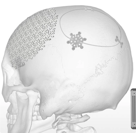 2osteomed_sistema_de_fixac_a_o_neurociru_rgica_fast_flap_2